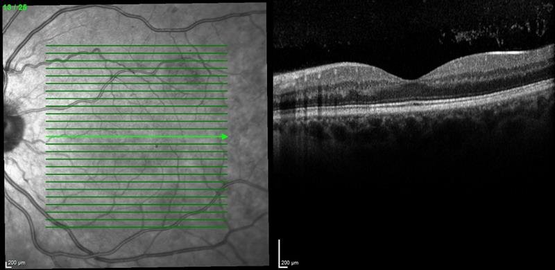 Computer screen showing the layers of the retina from an OCT scan